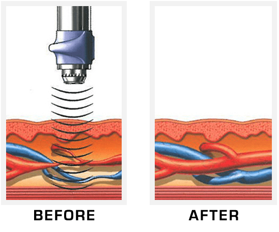 A before and after image of a laser treatment at Limelight Medical Spa, a Laser Center offering Wellness Services.