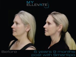 A woman's face before and after a procedure with smarlipo at a Cincinnati Health Spa.