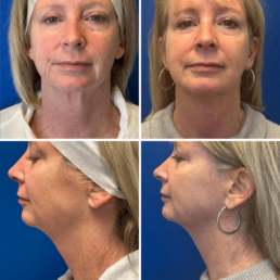 A woman's face before and after liposuction at a Cincinnati Health Spa.