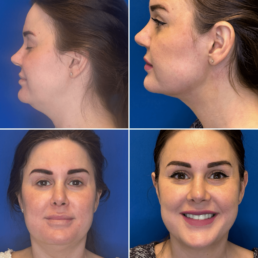 A woman's face before and after liposuction at a Laser Center in Cincinnati.