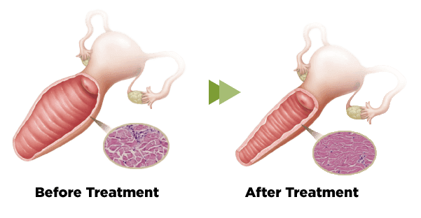 A picture of a stomach before and after treatment at Limelight Medical Spa, a leading Health Spa offering Wellness Services.