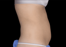 An image of a woman's stomach before and after liposuction at Limelight Medical Spa.