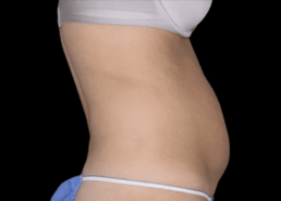 A woman's stomach before and after liposuction at Limelight Medical Spa in Cincinnati, offering wellness services.