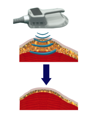 A diagram showing how a device is used in a Cincinnati health spa to treat a patient's skin during wellness services.