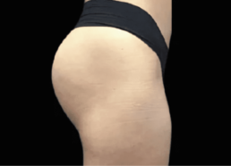 A woman's post-liposuction butt transformation at the Laser Center.