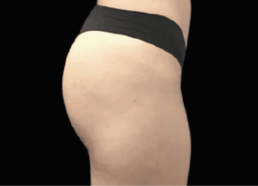 A woman's butt after undergoing liposuction at Limelight Medical Spa.