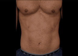 Tummy tuck before and after at Laser Center.