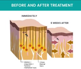 Diagram comparing skin layers immediately and 6 weeks after Morpheus8 treatment, illustrating tissue coagulation and healing process in the context of collagen induction therapy.