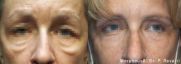 Before and after comparison of collagen induction therapy using Morpheus8, as indicated by Dr. P. Rovati.