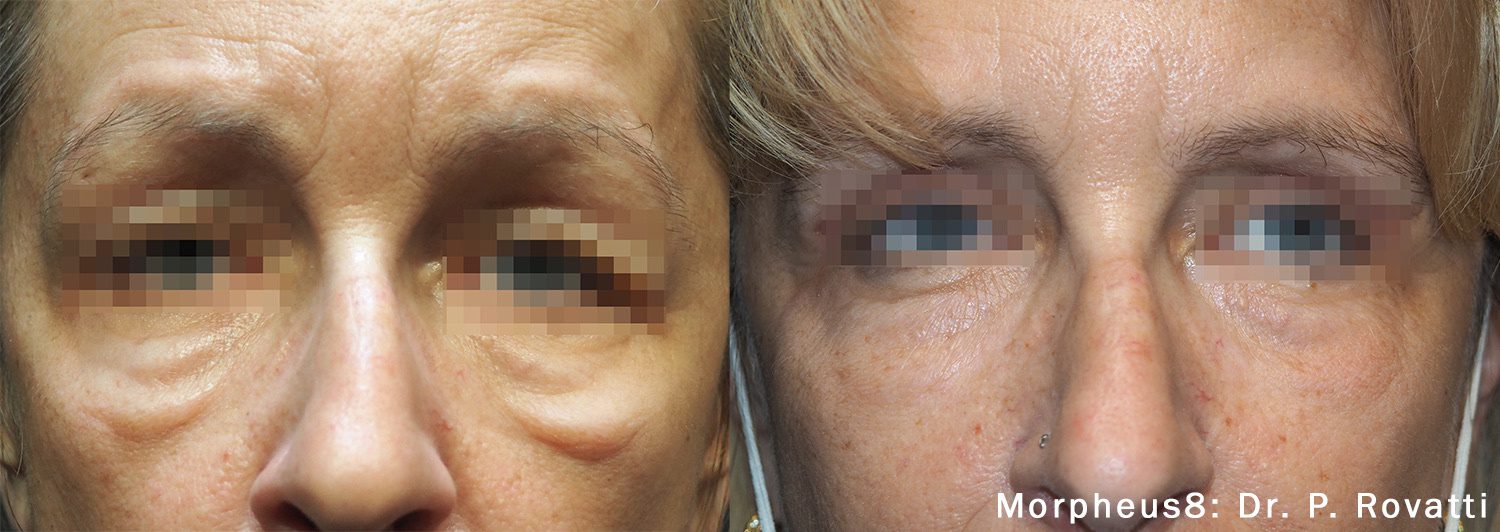 Before and after comparison of collagen induction therapy using Morpheus8, as indicated by Dr. P. Rovati.