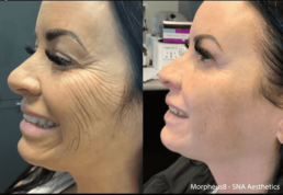 Before and after comparison of a woman's skin following a Morpheus8 microneedling treatment by SNA aesthetics.