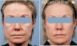 Before and after comparison of a woman's facial micro-needling procedure.
