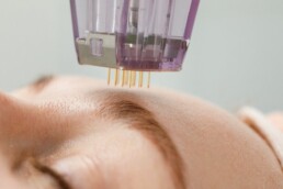 Micro-needling, a form of Collagen Induction Therapy, being performed on a person's forehead.