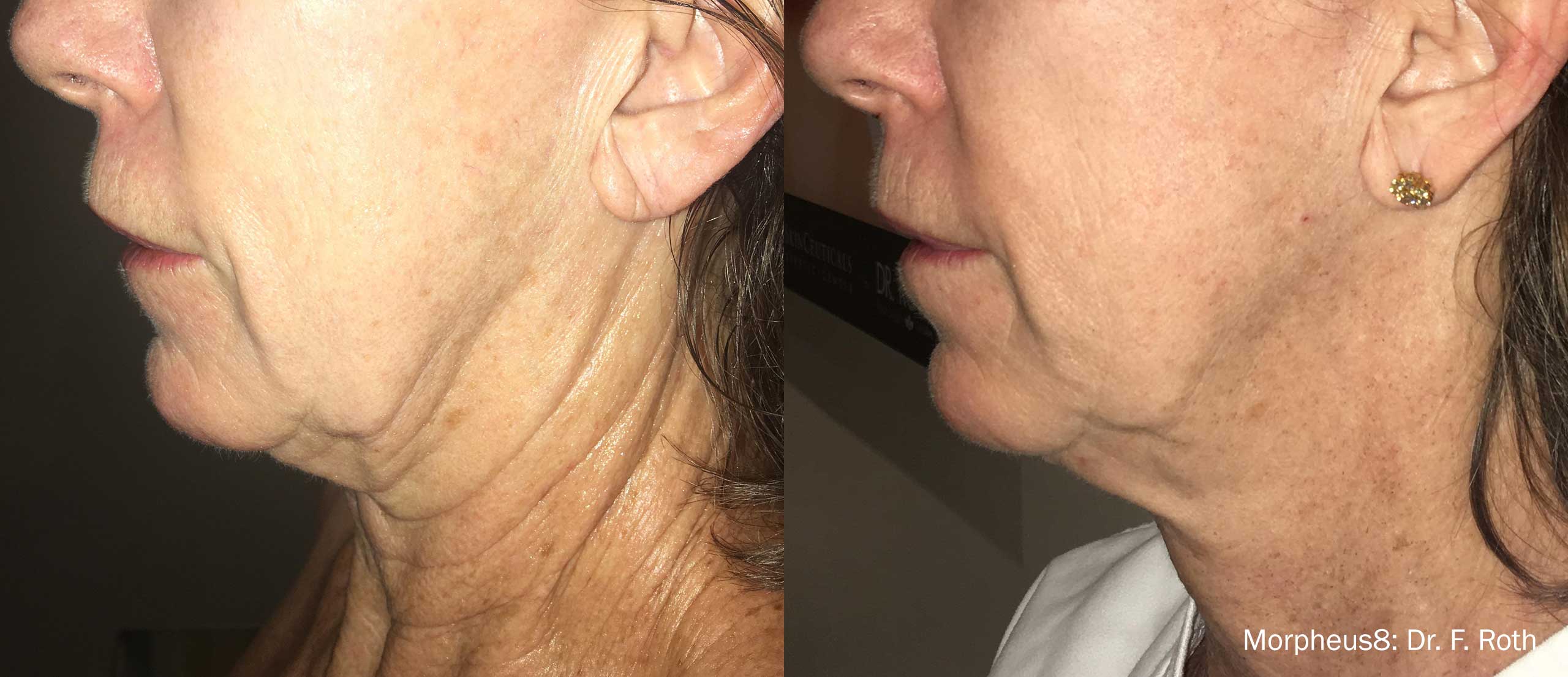 Before and after comparison of a neck treated with Morpheus8 micro-needling procedure, showcasing skin tightening and contour improvement.