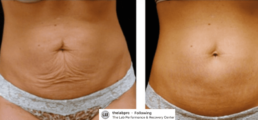 Before and after comparison of abdominal skin appearance following micro-needling collagen induction therapy.